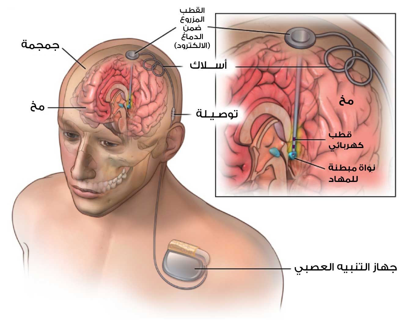 كيف يتم إجراء التحفيز العميق للدماغ