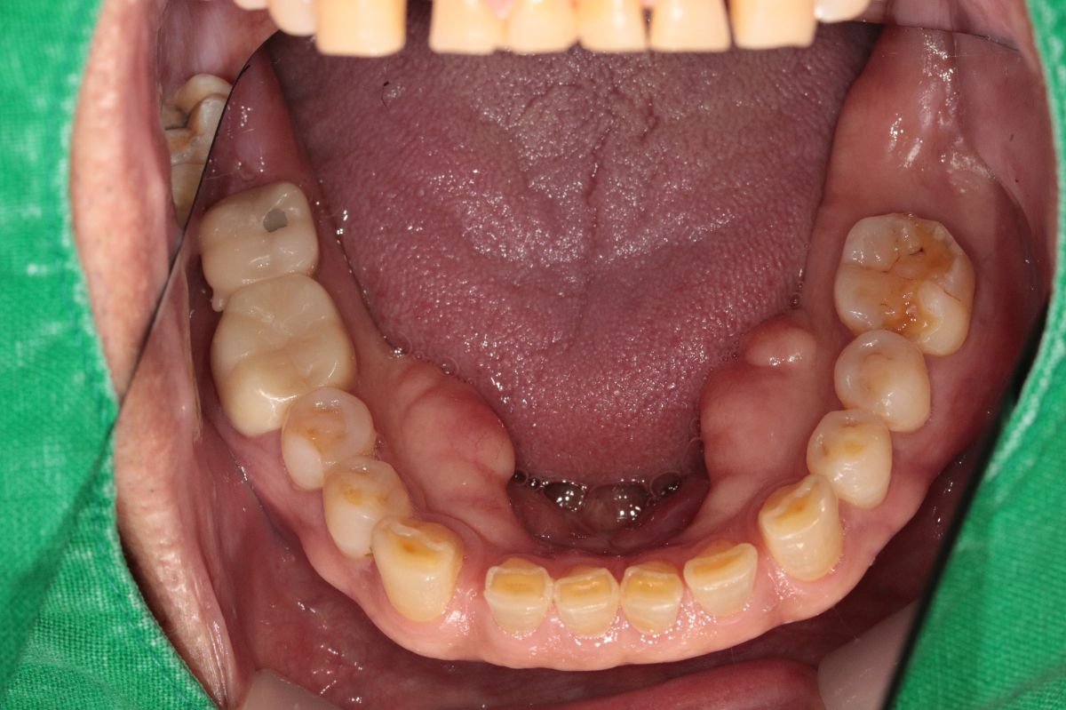 زراعة الأسنان بالغرز الداخلية